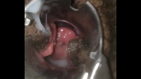 Pregnant open cervix scene